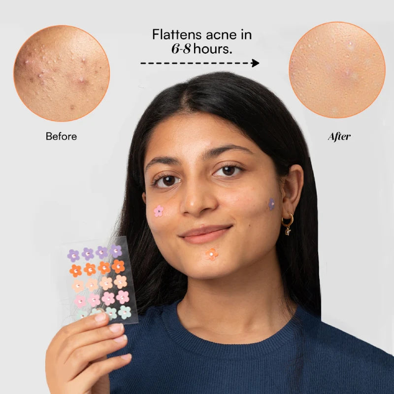 Dart It | Mini - Tea Tree & Hydrocolloid Acne Pimple Patches for Zits & Blemishes